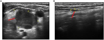 Case report: Mycobacterium chimaera-induced lymph node infection in a patient with chronic myeloproliferative neoplasm misdiagnosed as tuberculous lymphadenitis